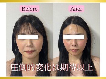 エレミュー(Elemue)/本気の小顔