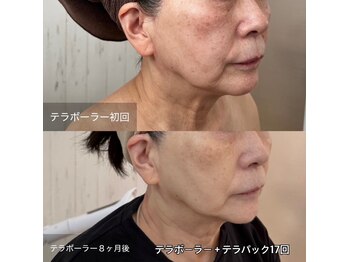 リアプア(Li'a)の写真/そのほうれい線今なら戻せます！ほうれい線・たるみを改善へ◎疲れ顔/たるみ/くすみ/大濠エステ/赤坂エステ