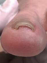 フルフィル 北千住/巻き爪　Befre