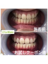 ルブラン 奈良店(Le Blanc)/ホワイトニングで自信を！！