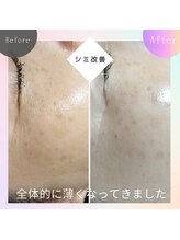 ロコモ 美容矯正サロン(Locomo)/シミケアとフェイシャルを交互に