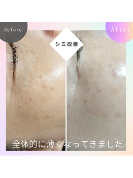 ロコモ 美容矯正サロン(Locomo)/シミケアとフェイシャルを交互に