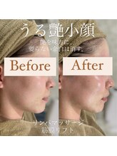 クリニカルホワイトケア 和泉府中店(クリニカルWHITEケア)/エラ張り改善と小顔(1回)