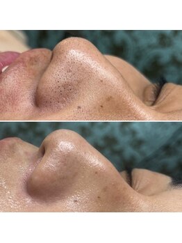 エステサロン ジョアアンジェ(joie ange)/手ごわい毛穴詰まりにも!