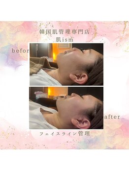 肌イズム 守谷店(肌ism)/【before&after】レモンボトル
