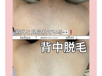 ベルミーランド 浜松天王/脱毛Before→After