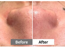 アーキ(ARCHI)/【稲沢/毛穴洗浄】毛穴洗浄