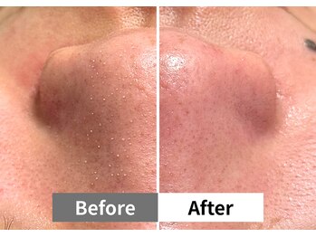 アーキ(ARCHI)/【稲沢/毛穴洗浄】毛穴洗浄