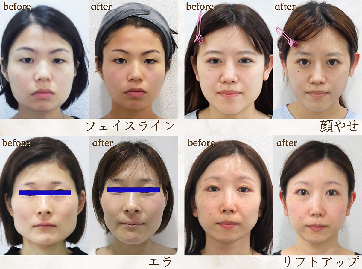 HEADRANG 小顔Vライン顔左右非対称矯正 横顔 小顔矯正に関するサロン 小顔サロン/VIOシュガーリング