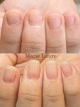 マリーロール 梅田店(Marie Laure)/自爪育成/深爪矯正/ネイルケア