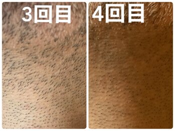 リジュ(Reju)/ヒゲ脱毛