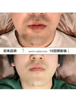 トゥルー(true)/ヒゲ脱毛　経過写真