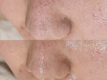 30代からの毛穴汚れ・黒ずみ・開きの徹底毛穴ケア！憧れの素肌へ