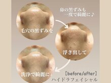 ダリア(Dahlia)/【ハイドラ毛穴洗浄の施術過程】