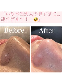 小顔屋ゆらやぎの写真/毛穴黒ずみごっそり！つるんと透明感肌へ♪