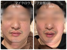 アムールドゥ 麻布十番(Amour deux)の雰囲気（1回で圧倒的な効果☆オンダリフト全顔顎下ガッツリシャープに）