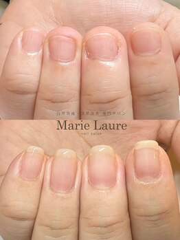 マリーロール 梅田店(Marie Laure)/自爪育成/深爪矯正/ネイルケア