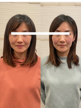 長寿鍼灸院 長寿整骨院/美容鍼50本の効果★(2回目）