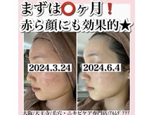 アルムダアクア 天王寺店(Aleumda AQUA)/毛穴エクストラクションプロ大阪