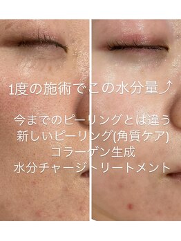 アネラ キキ サロン(anela kiki salon)/韓国美肌グレーズソフトピール