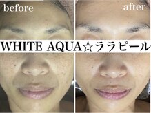 ホワイトアクア 錦糸町店(WHITE AQUA)/ララピール/毛穴/美白/錦糸町