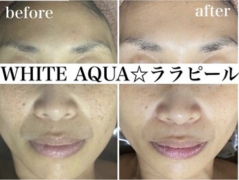 ホワイトアクア 錦糸町店(WHITE AQUA)/ララピール/毛穴/美白/錦糸町