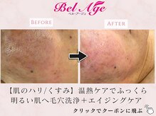 ベル アージュ/毛穴洗浄フェイシャル