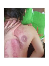 介正鍼灸整骨院つきぐま/肩甲骨はがし