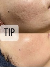 イベリス(Iberis)/ハーブピーリング/ニキビケア