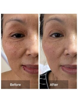 サロン ド アヤ(salon de Aya)/美白　『シワ・たるみ改善』