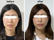 サロンスマイル/30代美容鍼ビフォーアフター