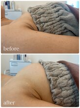 リノ 行橋(lino)/◇バストアップ症例◇30代