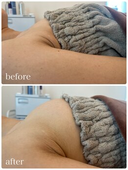 リノ 行橋(lino)/◇バストアップ症例◇30代