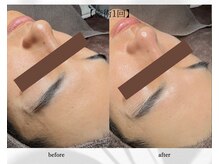 アン ビューティー(ann beauty)/施術1回【症例写真】20代