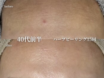 コウル 川西能勢口店(geoul)/肌質改善コース
