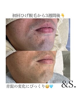 アンドエス(&S.)/初回から効果がわかるひげ脱毛☆