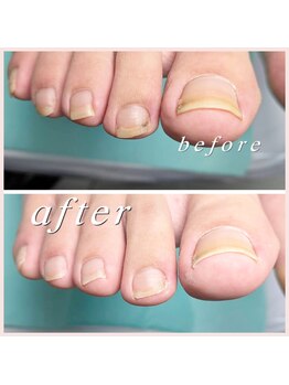 巻き爪補正店 大阪なんば店/爪切り