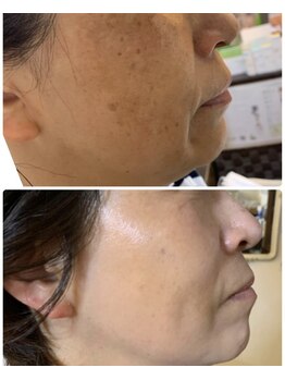 サロン エム(Salon M)/コンテスト受賞 しみ改善60代