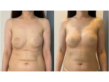 モア(moa)/バストケア2回目