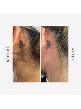 ブランスキンラボ(BLANC.skin LAB)/うなじワックス脱毛