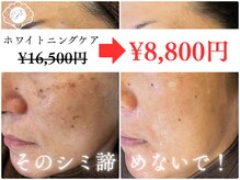 シミケア+素肌も綺麗に◎ 大小問わずケア可能