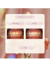 プラスビー 2号店(+b)/ホワイトニングビフォーアフター