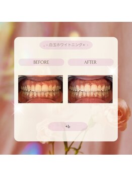 プラスビー 2号店(+b)/ホワイトニングビフォーアフター