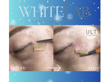 ウルト アルティメイトスキン(ULT ultimate skin)/最新シミケア