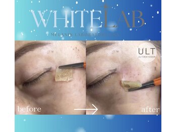 ウルト アルティメイトスキン(ULT ultimate skin)/最新シミケア