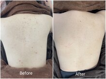 ライフ美容整体院 恵比寿(Life美容整体院)/背中ハーブピーリング