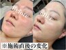 NEW★《敏感肌/繰り返すニキビに》肌育ピール通常￥18800→￥12200