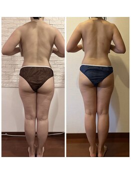 うつくし痩身 美サロン ゼットワン(Z-ONE)/筋膜リリースメディセル３回