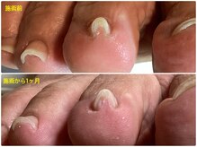 フットケアリストシュウ(footcarelist shu)/施術【巻き爪改善】
