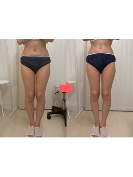 エルベ(ellbe)/【筋膜痩身】スッキリ美脚ケア